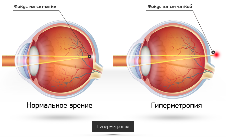 Гиперметропия средней степени глаза. Гиперметропия слабой степени 52.0. Патология рефракции гиперметропия. Глазные болезни гиперметропия. H52.0 гиперметропия.