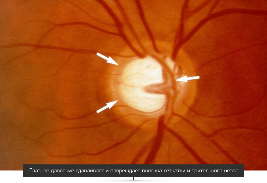 Нейропатия глаза. Глаукомная атрофия зрительного нерва. Зрительный нерв глаукома. Глаукомная экскавация ДЗН. Нейропатия зрительного нерва Лебера.
