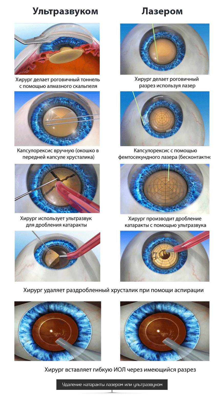 Факоэмульсификация катаракты этапы операции. Ультразвуковая факоэмульсификация катаракты этапы. Ультразвуковое хирургия катаракты - факоэмульсификация. Техника факоэмульсификации катаракты с имплантацией ИОЛ.
